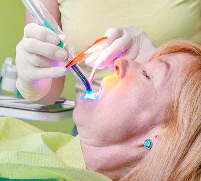 Dental Bonding procedure in Mt. Dora