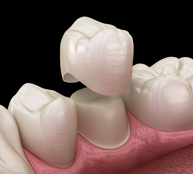 Animated dental crown placement