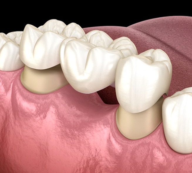 dental bridge in Mt. Dora replacing a single missing tooth