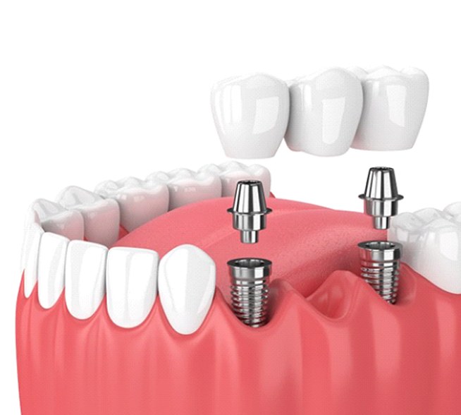 dental bridge being placed on top of two dental implants