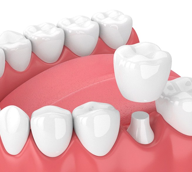Diagram of dental crown in Tyler