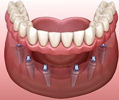 an example of implant dentures in Mt. Dora