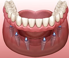 an example of implant dentures in Mt. Dora
