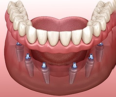 Implant dentures in Mt. Dora