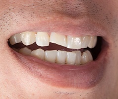 Smile with chipped tooth