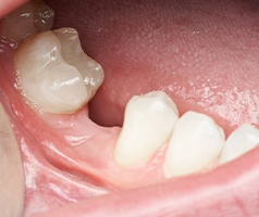 Smile with knocked out tooth