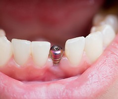 An up-close image of a dental implant post located on the lower arch between two healthy teeth