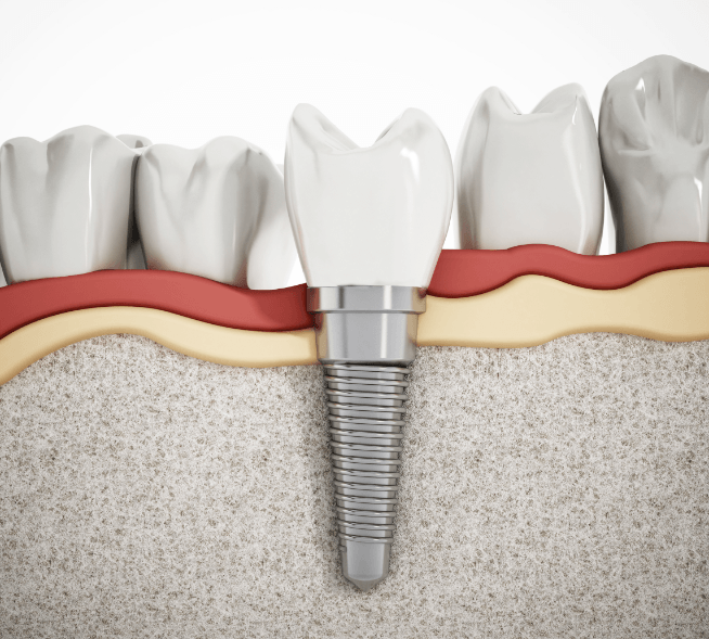 Animated implant supported dental crown