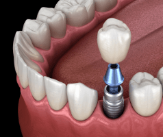 Animated implant supported dental crown