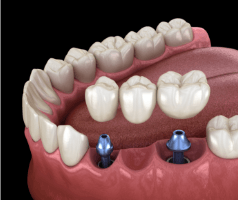 Animated implant supported fixed bridge