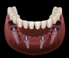 Animated implant supported denture