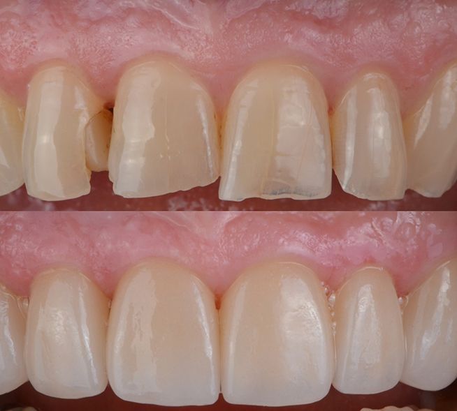 Before and after images of a person’s teeth after having a smile makeover