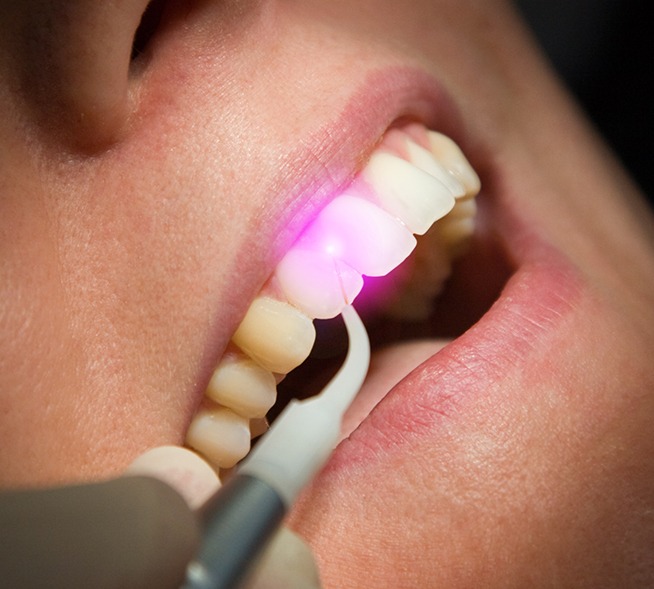 Closeup of smile during laser dentistry treatment