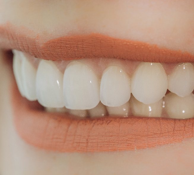 Closeup of beautiful smile with porcelain veneers in Mt. Dora