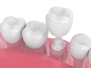 Illustration of a metal-free dental crown being placed on a prepared tooth