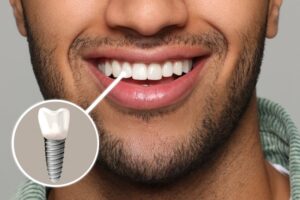Man with a dental implant smiling wide